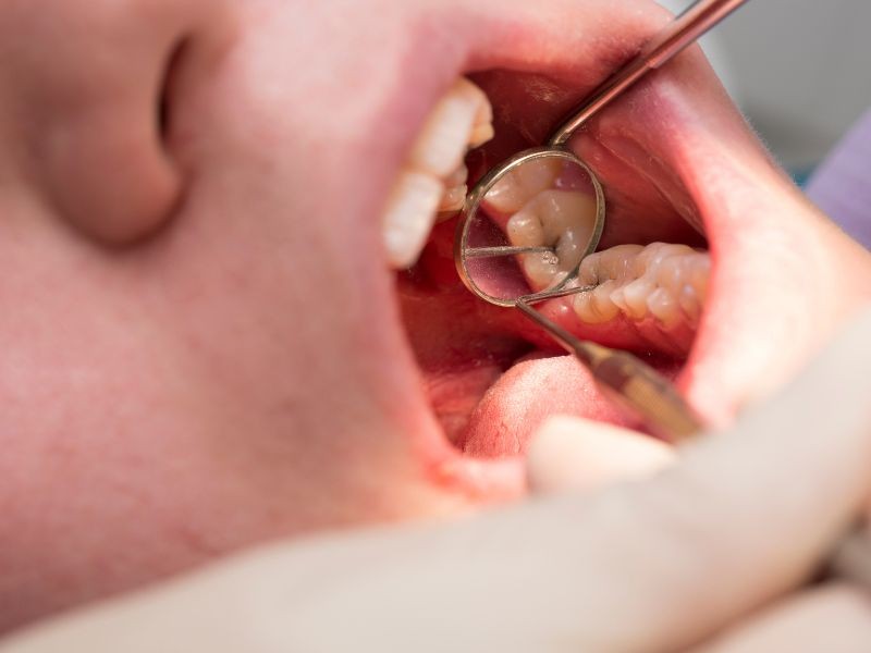 O que Causa Cárie e Como Evitar?