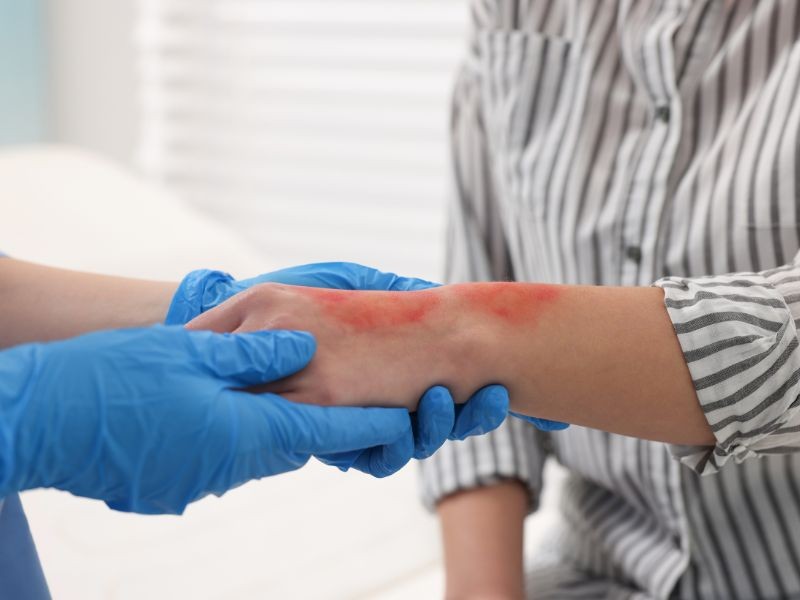 Bicho Geográfico: Sintomas, Tratamento e Como Prevenir