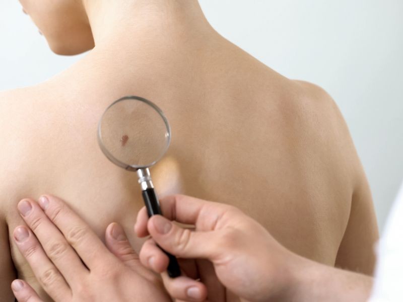 Esse Sinal pode ser Câncer de Pele? Como Descobrir?