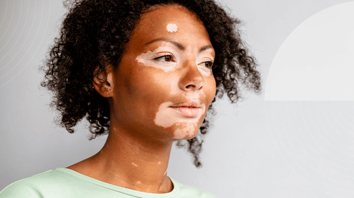 Doenças autoimunes e autoestima