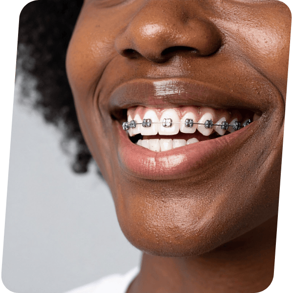 Aparelhos Ortodônticos