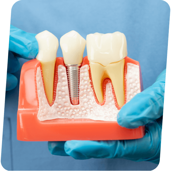 Implantes Dentários